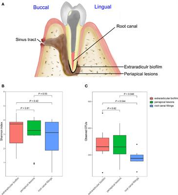 Microbial Communities in the Extraradicular and Intraradicular Infections Associated With Persistent Apical Periodontitis